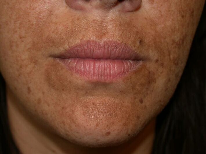 Manchas pigmentadas no rosto são uma indicação para um procedimento a laser