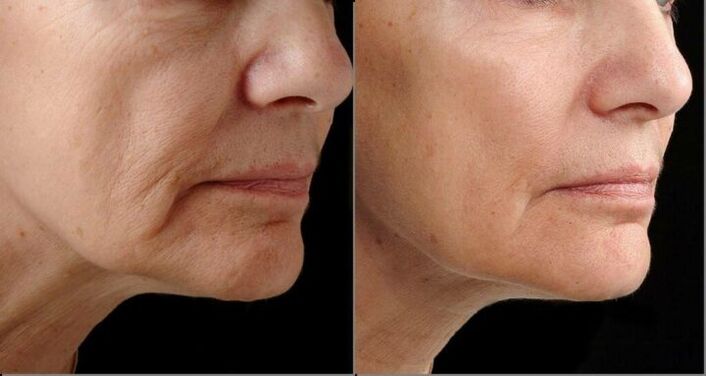 Pele facial antes e depois do procedimento de rejuvenescimento a laser