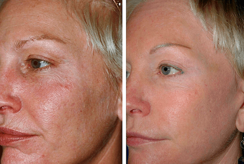 antes e depois do rejuvenescimento fracionado da pele foto 1