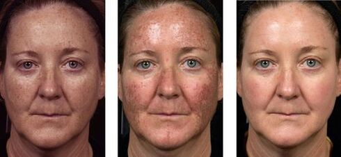 antes e depois do rejuvenescimento fracionado da pele foto 2