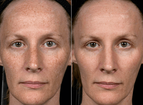 antes e depois do rejuvenescimento fracionado da pele foto 3