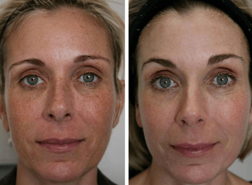 antes e depois do rejuvenescimento fracionado da pele foto 4