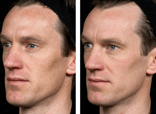 antes e depois do rejuvenescimento fracionado da pele foto 5