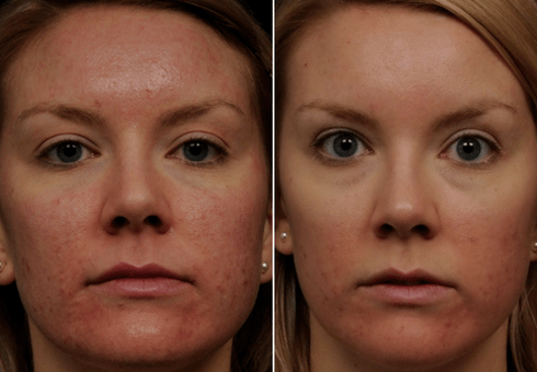 antes e depois do rejuvenescimento fracionado da pele foto 6