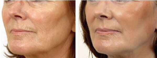 Antes e depois do descascamento do laser