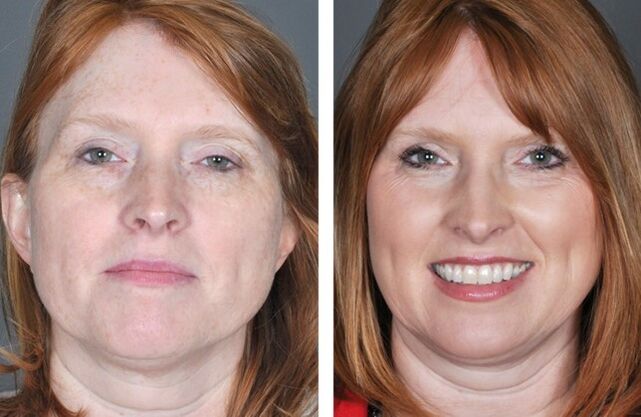 Procedimento de rejuvenescimento facial antes e depois de uma série de procedimentos