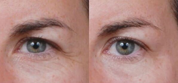 Rejuvenescimento das pálpebras