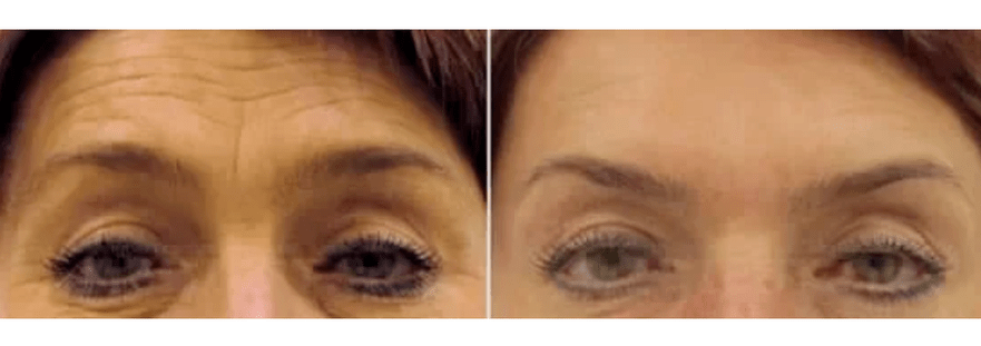 dispositivos para rejuvenescimento fracionado