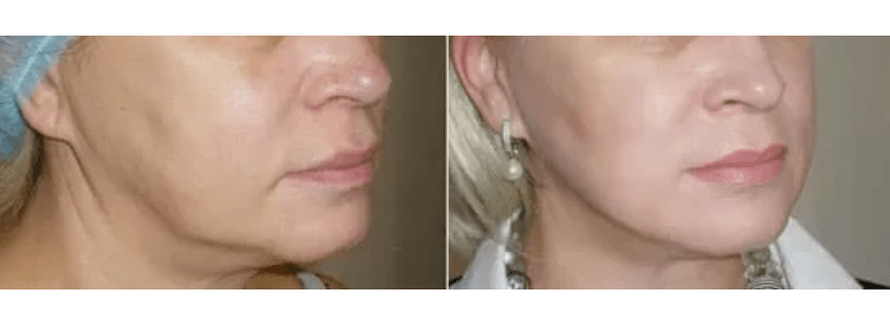 recuperação após rejuvenescimento da pele