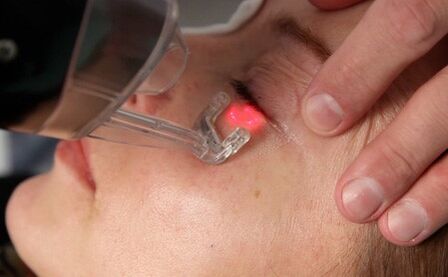procedimento de rejuvenescimento da pele facial a laser