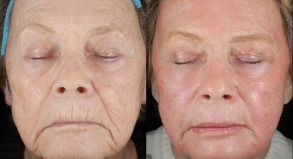 antes e depois do rejuvenescimento a laser